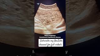 Molar pregnency in ultrasoundusg of pelvis Molar pregnancy ultrasound [upl. by Nalani624]