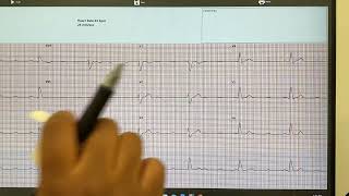 Analyzing an AtrioVentricular AV Heart Block and an Irregularly irregular Rhythm [upl. by Schiffman558]