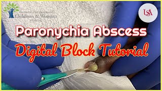 Finger Paronychia Emergency amp Digital Block Tutorial [upl. by Cence]