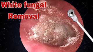 Ear Wax amp White Fungal Removal  Doctor Anh [upl. by Aicekan423]