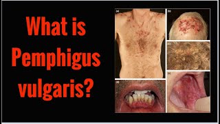 What is PEMPHIGUS VULGARIS Symptoms Causes [upl. by Rojam568]