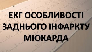 ІНФАРКТ МІОКАРДА ЗАДНЬОЇ СТІНКИ ЕКГ  ОСОБЛИВОСТІ [upl. by Ennahgem]