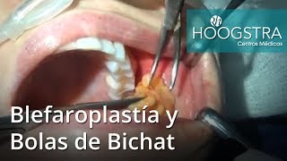 Blefaroplastía y Bolas de Bichat 18170 [upl. by Sitoeht]