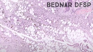 Bednar tumor dermatofibrosarcoma protuberans DFSP with melanin pigment pathology dermatology [upl. by Rairb]