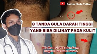 8 Tanda Kulit Kamu Mengalami Gula Darah Tinggi  DIABETES dokyudra [upl. by Nored]