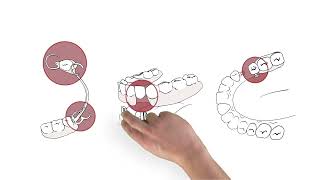Zahnersatz – Teilprothesen oder Vollprothesen richtig einsetzen und rausnehmen 2016 [upl. by Mariska]