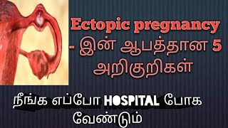 ectopic pregnancy symptoms in tamil  pregnancy symptoms in tamil  Puguntha veedu [upl. by Canica169]