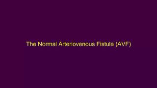 The Normal Arteriovenous Fistula [upl. by Dahc]