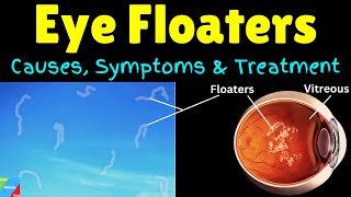 What are Eye Floaters  Causes Symptoms Treatment amp Prevention [upl. by Chambers]