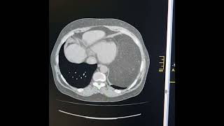 Mediastinal lipoma Mediastinal lipomatosis [upl. by Elstan]