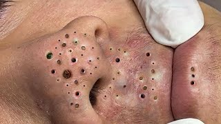 Big Cystic Acne Blackheads Extraction Blackheads amp Milia Whiteheads Removal Pimple Popping  2707 [upl. by Tserrof]