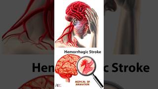 Hemorrhagic Stroke medical animation 3d short biology With Aliya [upl. by Aldridge]