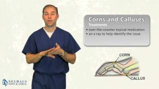 What is the Difference Between a Corn and a Callus on the Foot [upl. by Ordnaxela]