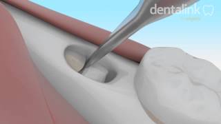 Exodoncia COMPLEJA tercer molar incluido  Video 3D paso a paso [upl. by Ylhsa]