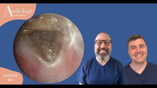 SKIN ENCASED EAR WAX PLUG REMOVAL EP802 [upl. by Helman82]