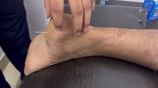 Heel Pain Treatment by Dry Needling Therapy  Full video [upl. by Hollinger]