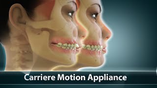 Carriere Motion Orthodontic Treatment  Curveia Dental Animation  Patient Education Video [upl. by Hnao661]