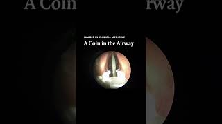 NEJM Images in Clinical Medicine A Coin in the Airway [upl. by Elissa]