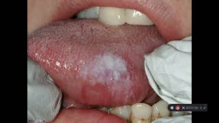 Oral cancer and precancer part 3 Leukoplakia and Erythroplakia [upl. by Gladine839]