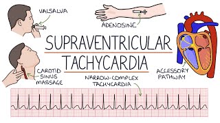 Understanding Supraventricular Tachycardia SVT [upl. by Anaet]