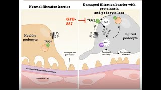 Kidney Disease Treatment Goldfinch Study Recruiting [upl. by Jacklyn]