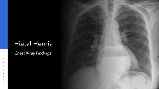 Hiatal Hernia Chest Xray [upl. by Saylor]