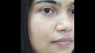 𝐃𝐫 𝐋𝐢𝐠𝐡𝐭 𝐀𝐜𝐧𝐞 𝐂𝐮𝐫𝐞 𝐓𝐫𝐞𝐚𝐭𝐦𝐞𝐧𝐭  BioXin Magical Treatment  Acne Treatment [upl. by Ardnaeel]