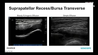 Webinar Ultrasound Evaluation of the Anterior Knee [upl. by Yank103]