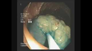 Polypectomy Colon  Ascentic Colon Granular LST  EMR  APC  STEFANOS DOKAS  The ERCP Channel [upl. by Ened230]