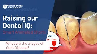 What are the Stages of Gum Disease  Western Dental [upl. by Denni]