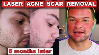 Acne Scar Removal Before And After 6 Months Fractional C02 Laser Skin Resurfacing [upl. by Vanna465]