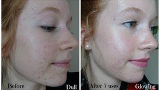 Personal Microderm Review PMD Demo and Before amp After Pictures [upl. by Lsiel]