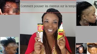 Comment FAIRE POUSSER les tempes degarnies [upl. by Kreager]