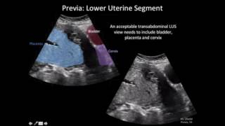 Ultrasound Diagnosis of Placenta Accreta A Tutorial for Imagers [upl. by Nelleyram724]