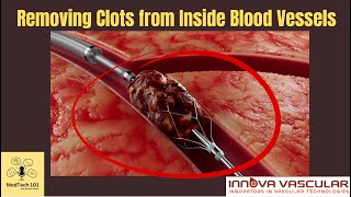 Removal of Clots from Veins and Arteries Without Open Surgery with CEO Sanjay Shrivastava  Ep 43 [upl. by Curzon]