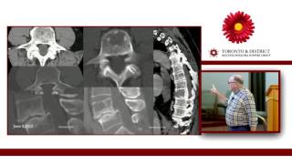 Kyphoplasty Vertebral Augmentation for Myeloma The Cement Facts  Is It Worth It [upl. by Mauretta]