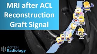 Knee MRI after ACL Reconstruction Surgery  Part 1  Signal intensity [upl. by Franciska]