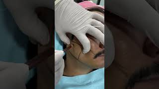 Botox Injection into Masseter Muscle for Face Slimming botox faceslimming [upl. by Elime]