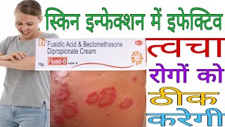 Flusid B Cream Benefits and side effects in Hindi  फ्लूसिड बी क्रीम के फायदे और नुकसान [upl. by Eenwat]