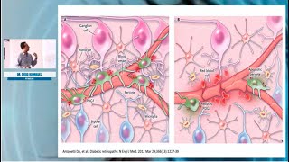 Conferencia Académica Aspectos CLAVES del Edema Macular Diabético  Sociedad de Cirugía Ocular SA [upl. by Mcnelly]