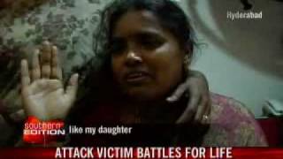 Girl burnt in acid attack fights for life [upl. by Lipp]