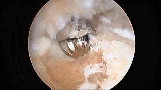 Calcaneoplasty Arthroscopic Surgery for Removal Haglunds Deformity for Heel Pain SFISM [upl. by Babcock]