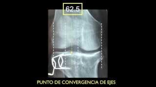 OSTEOTOMIA TIBIAL ALTA PLANEACION [upl. by Hepzi61]