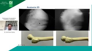 Radioscopia intra operatória armadilhas e limitações  Dr Kodi Kojima [upl. by Akalam]