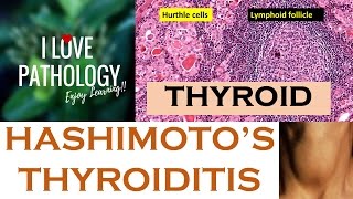 HASHIMOTOS THYROIDITIS Etiopathogenesis Morphology amp Complications [upl. by Aubreir]