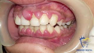 Severe gingivitis amp gingival hyperplasia [upl. by Jordison788]