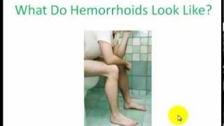 What Do Hemorrhoids Look Like  The Two Types Of Hemorrhoids Explained [upl. by Violette952]