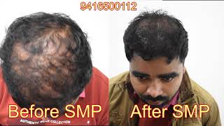 Result of SMP  Before after  Scalp Micropigmentation [upl. by Olyhs]