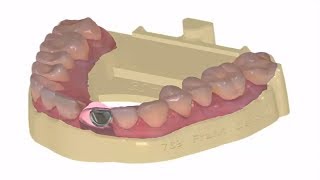 3Shape Dental System  Model Builder  Implant Model [upl. by Anaihk]