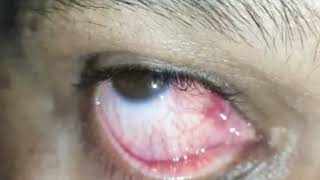 Episcleritis Ophthalmology clinical signs shorts [upl. by Aicital793]